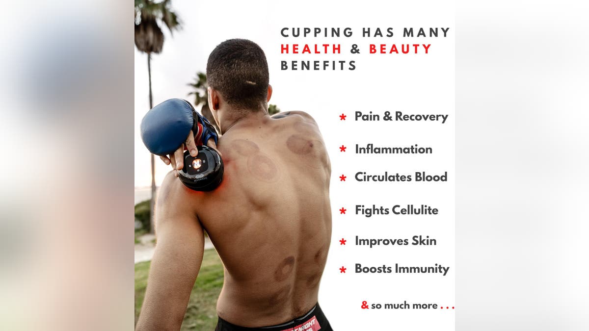 Cupping is an alternative therapy quickly gaining ground.