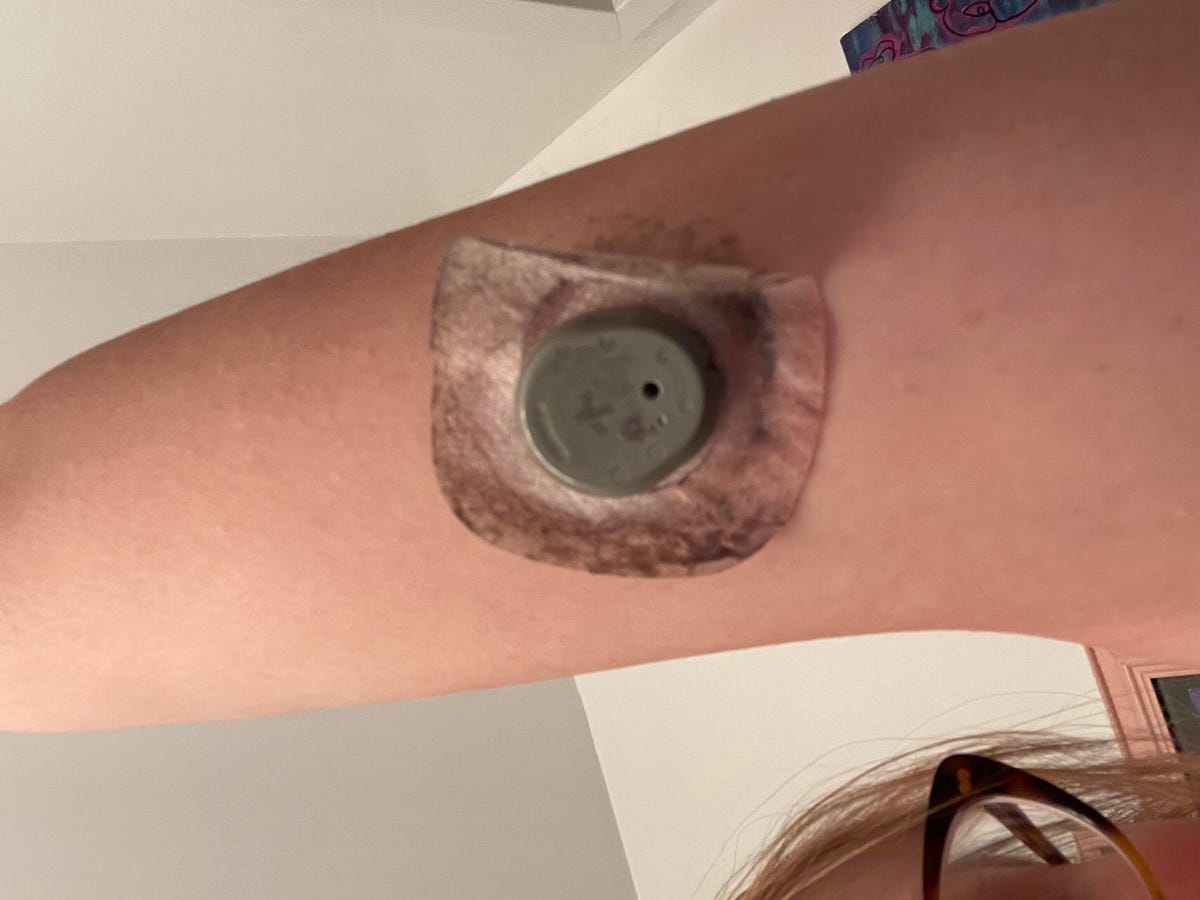 A photo of a biosensor on the back of the arm