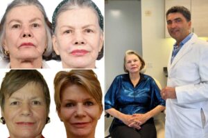 New Yorkers are getting second and third facelifts in quest for eternal youth: ‘Life expectancy is going up … I don’t know if we can say four is too many’
