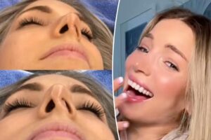 I scored a ‘free’ nose job — then got the shock of my life that came with a K pricetag