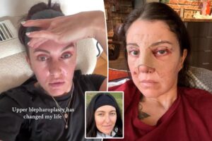 I spent K on a nose job, eyelid surgery before my wedding — it was worth every penny