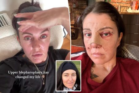 I spent K on a nose job, eyelid surgery before my wedding — it was worth every penny