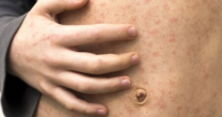 Measles cases continue to rise in Manitoba as outbreaks spread