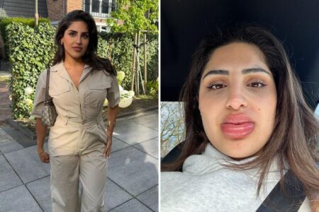 My lip filler dissolving treatment went horribly wrong — and left me looking like a Bratz doll