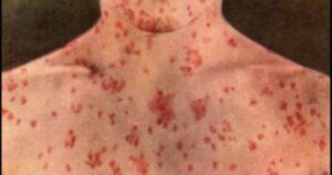 New measles cases detected in B.C.’s Interior, including airports