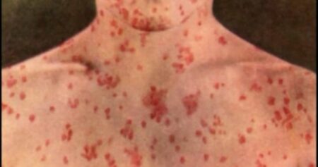 New measles cases detected in B.C.’s Interior, including airports