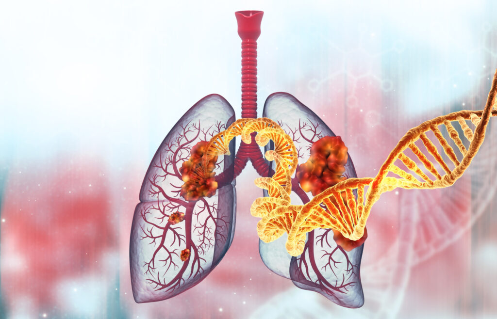 Never-Smokers’ Lung Cancer May Worsen in Areas With Air Pollution