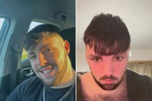 Horny hair transplant patient says his head ‘blew up like a balloon’ after ignoring a surprising post-surgery rule: ‘Too hard too soon’