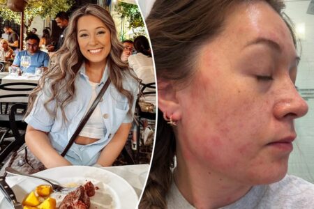 Exclusive | I’m a vegan against my will after developing an overnight allergy that’s increasing across the US