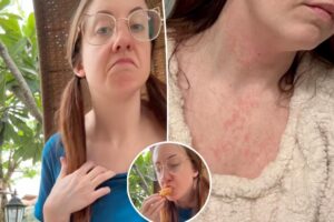 Severe ‘allergies’ forced woman to leave the US — foreign diets had a shocking effect on her body