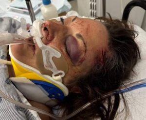 Montreal cyclist says it’s a ‘miracle’ she’s alive after hitting a pothole, going into coma