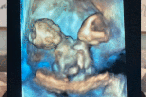 Mom Learns She’s Having Conjoined Twin Girls—Given Two Devastating Choices