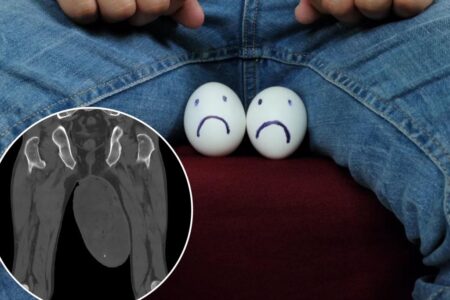 Tumor the size of a chicken egg found in man’s scrotum — due to rare condition usually found in vaginas