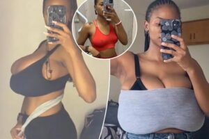 My 32A breasts grew to a 34G-cup in a matter of months due to a super rare condition