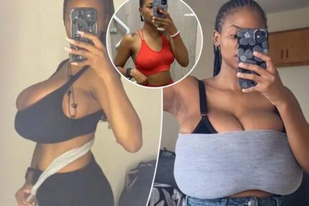 My 32A breasts grew to a 34G-cup in a matter of months due to a super rare condition