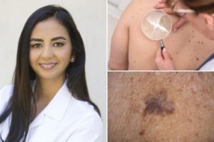 The ‘ABCDEs’ of skin cancer — 9 clues you shouldn’t ignore