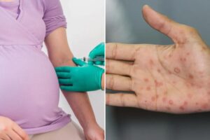 Three babies die amid ‘concerning rise’ of syphilis in New York — what to know about the dangerous disease