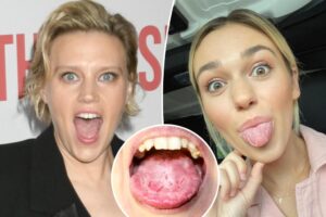 What is ‘geographic tongue’? All about ‘SNL’ star Kate McKinnon’s ‘gross’ condition