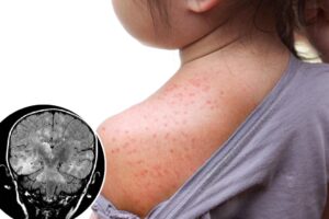This deadly brain disorder can develop a decade after you get the measles — and it just killed a child