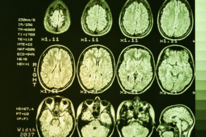 Huntington’s Disease Treatment Breakthrough: What to Know