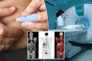 ‘Unusual’ new side effect of drugs like Ozempic becoming ‘increasingly common’