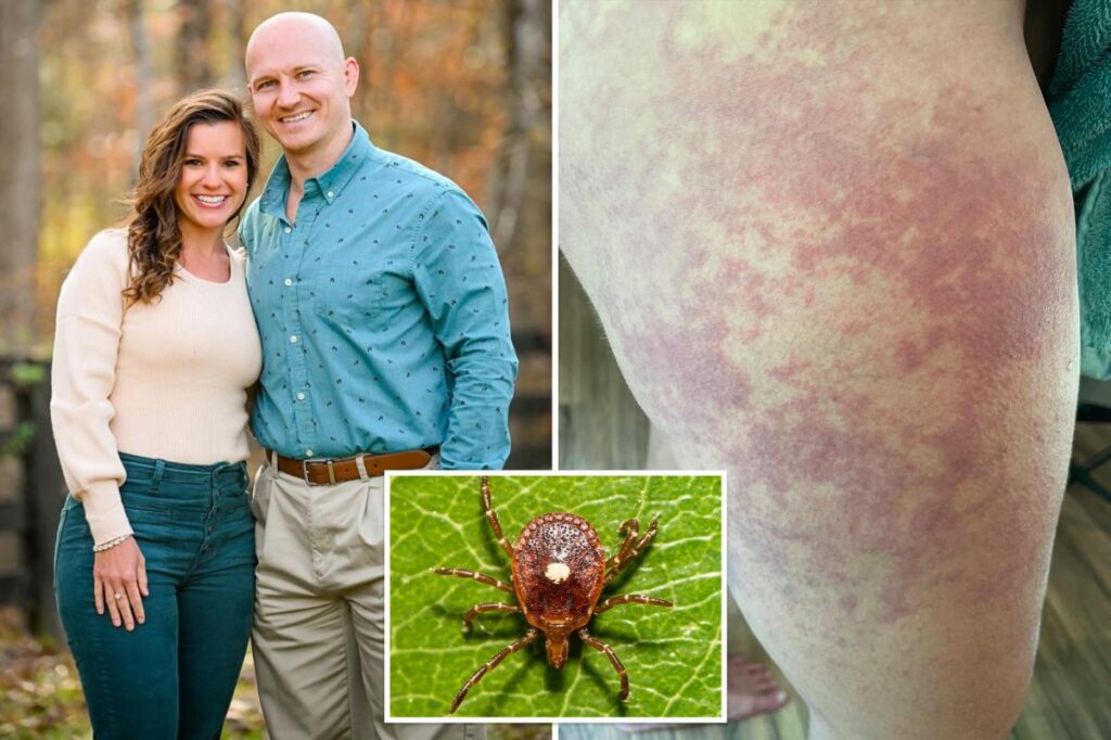 I live with alpha-gal syndrome — a tick-borne illness that makes you allergic to meat products — and my life is hell