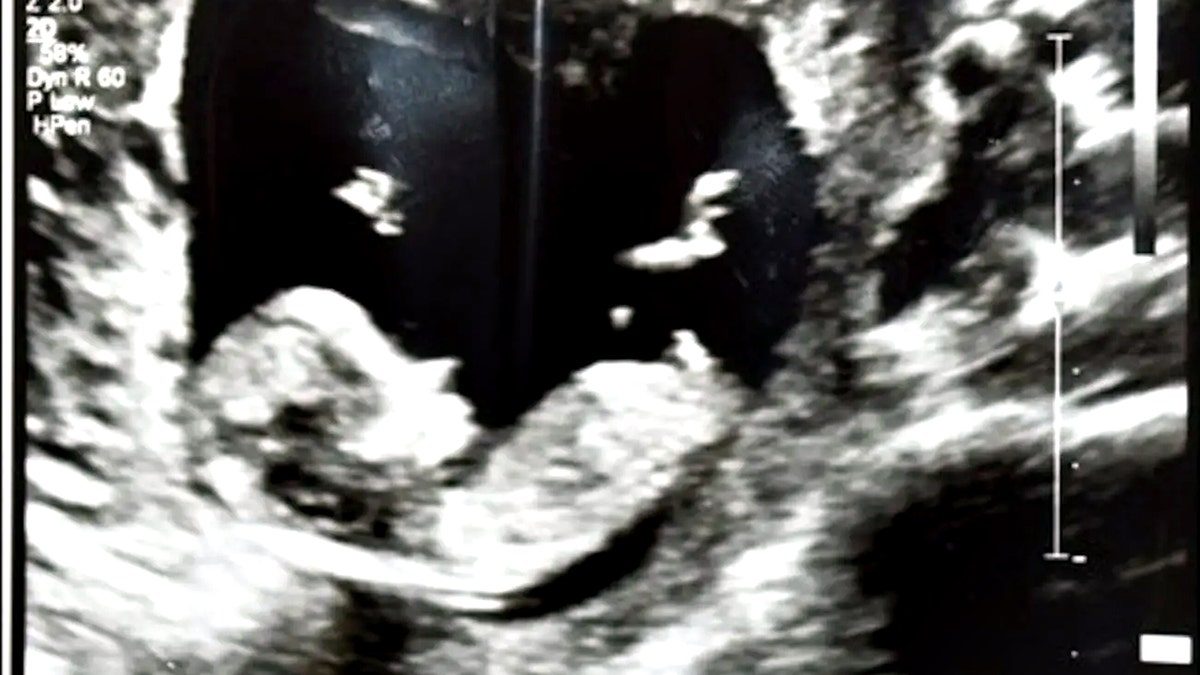 ultrasound of Fiengo's unborn baby