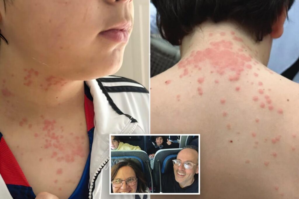 Virginia family suing KLM after flight was allegedly ‘infested’ with bedbugs: ‘Itchy welts, lesions and rashes’