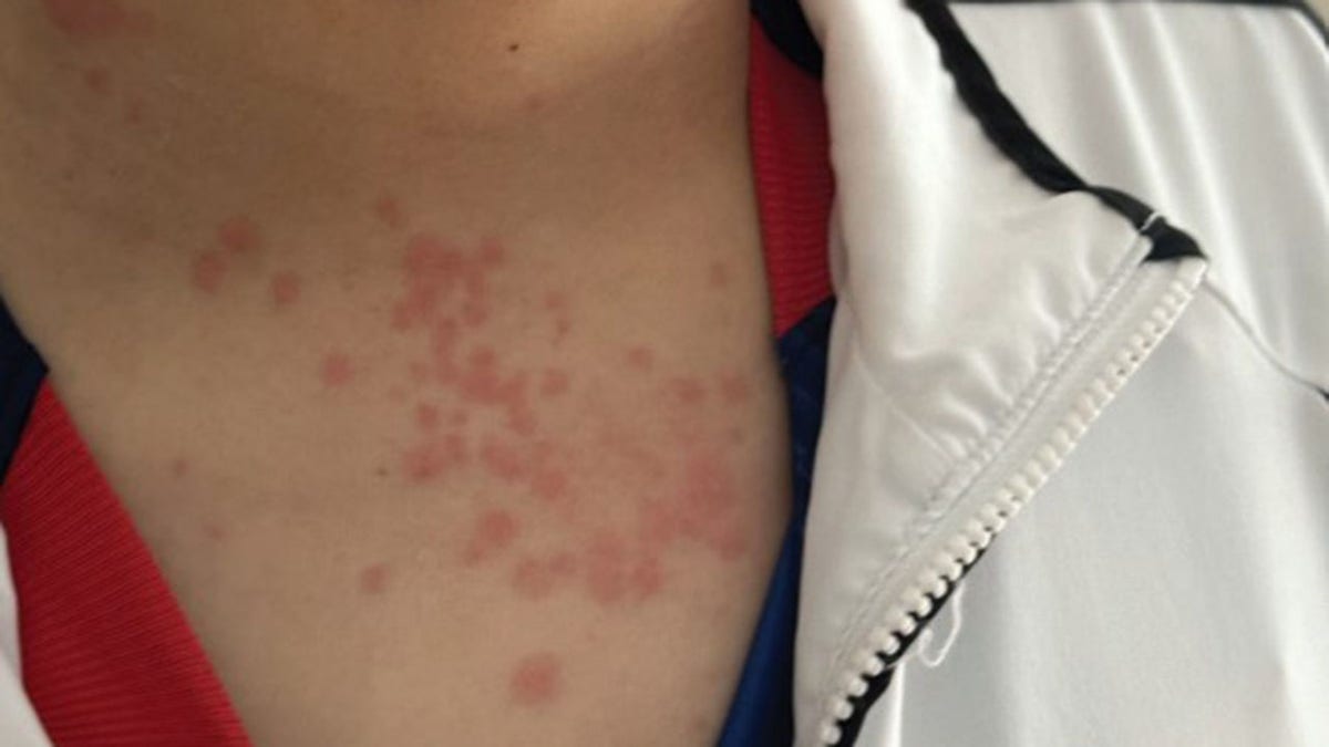 A member of the Albuquerque family with bed bug bites