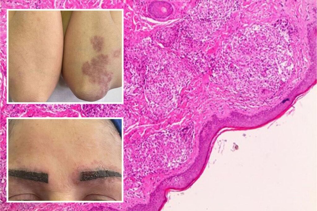 How a popular makeup trend triggered one woman’s full-body disease