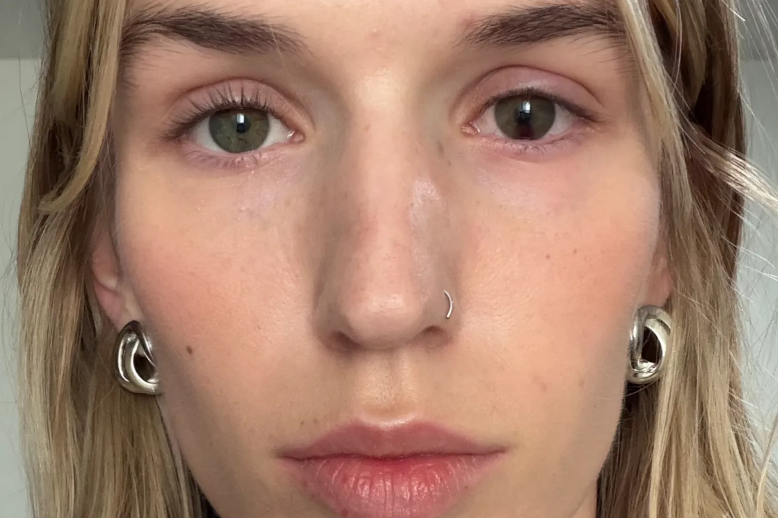 Sarah Bell was left with lasting damage to her eye, as one pupil is 0.6mm bigger than the other.