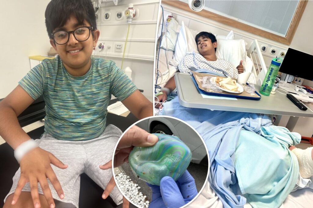 Boy, 12, undergoes skin graft after sun exposure caused popular toy to explode
