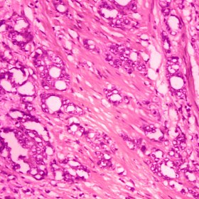 An image of changes in cells indicative of prostate cancer. 