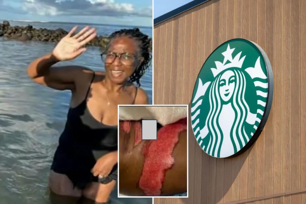 Starbucks horror as SoCal woman says boiling coffee spill led to surgery