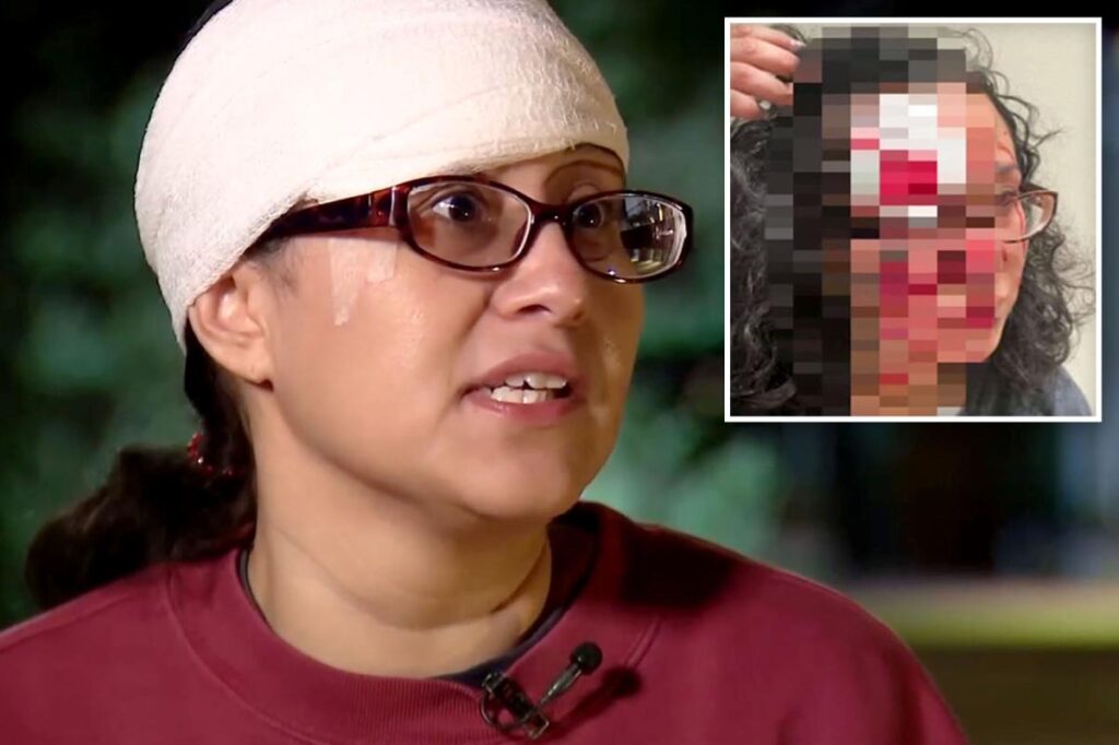 Woman accused of biting chunk out of victim’s forehead in ‘zombie bite’ attack