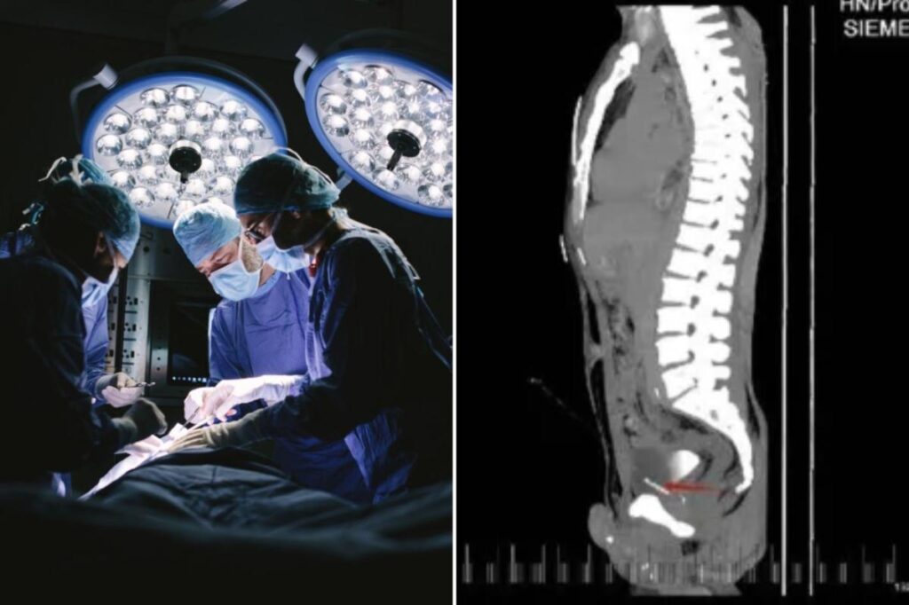 Doctors find shocking ‘foreign bodies’ inside a man’s chest, pelvis, bladder — and penis Doctors find shocking ‘foreign bodies’ inside a man’s chest, pelvis, bladder — and penis